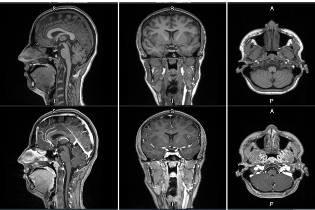 First-in-human contrast enhanced MRI images with GE HealthCare’s mangaciclanol