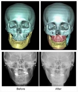 3D CT(3차원 영상분석)는 입체적인 측정을 통해 얼굴의 외부뿐만 아니라 얼굴 내부 뼈의