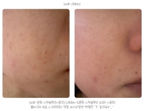 한 테스터참가 회원의 스팟솔루션(사용전)과 (사용후)