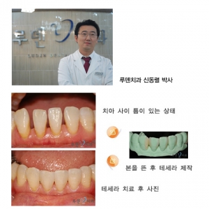 치아 사이 틈 메우기…삭제 없는 ‘테세라’로 치료