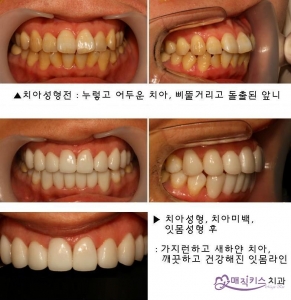 치아성형, 라미네이트, 치아미백, 잇몸성형 시술 직후 가지런하고 깨끗해진 치아와 잇몸의 모