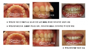 돌출입을 해결하는 방식 중 가장 안전한 방법은 바로 치아교정이다. 사진은 투명교정만으로 입