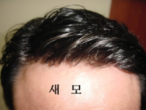 이마 부분만 클로즈업한 사진.