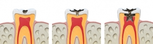 아이의 충치를 예방하기 위해서는 부모의 관심과 바른 칫솔질, 치아 정기검진이 필요하다.