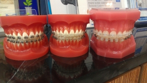 요즘 치아교정치료는 심미적, 기능적인 효과로 인해 인기가 많다.