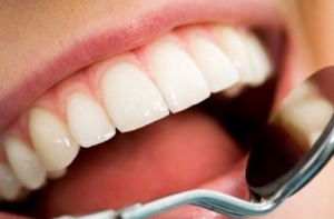 치아미백은 과산화수소를 이용하여 치아를 착색시키는 물질의 구조를 파악하고 원인을 제거하여 