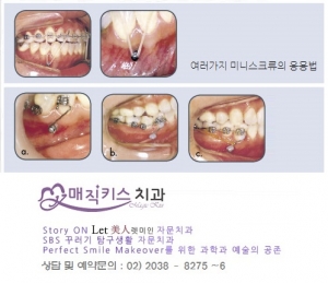 미니스크류를 이용한 여러가지 치아교정술식의 응용