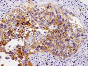 PD-L1 (E1L3N) XP® 토끼 단일 클론 항체를 이용한 파라핀 내장 인간 폐암 세포