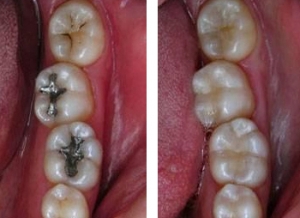 아말감으로 충치를 치료한 치아는 다른 재료에 비해 접착력이 약하고, 사용 중에 부분적으로 