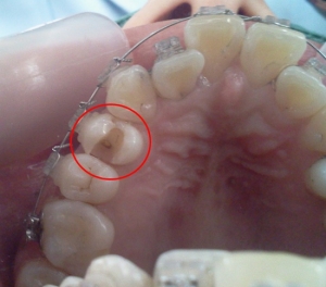 치아 교정장치의 탈부착 없이 치아 교정중에 생긴 충치를 제거한 사진이다.