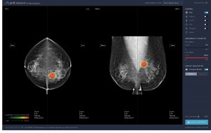 식품의약품안전처 허가를 받은 유방암 진단 보조 소프트웨어 ‘루닛 인사이트 MMG’ 온라인 