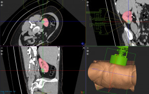 Example of HistoSonics technology targeting kidney