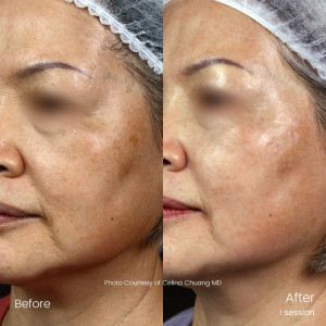 Pico Filling Treatment - skin rejuvenation (Photo: