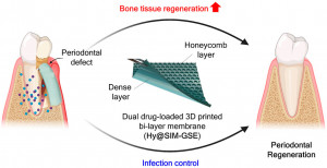 3D프린팅으로 제작된 차별적 이중층 막은 벌집 모양과 밀집된 층으로 구성된 치주조직의 계층적 구조를 모방한다. 제안된 구조물은 이중 약물 전달 시스템으로서, 뼈 조직 재생을 촉진하는 약물인 심바스타틴(SIM)과 항균 특성을 가진 경제적인 천연 화합물인 포도씨 추출물(G...