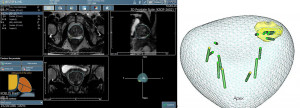 SNU건전비뇨의학과 원데이 전립선 MRI 연동 표적 조직검사 결과