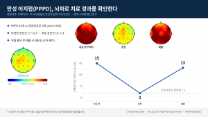 만성 어지럼(PPPD) 환자의 정량뇌파 고베타(25~30㎐) 활동은 치료로 호전되면 건강대조군 수준까지 낮아지고, 약을 중단해 재발하면 다시 올라간다(제공=천안삼성스마트신경과의원)